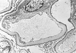 M,20y. | IgA nephropathy (Berger disease)